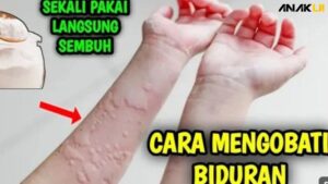 Cara Mengatasi Biduran