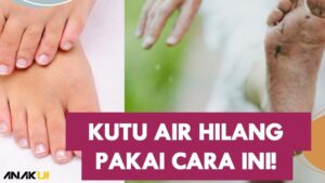 Cara Menghilangkan Kutu Air