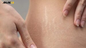 Cara Menghilangkan Stretch Mark